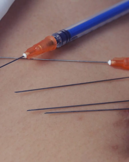 Navel needle-Sasa 5