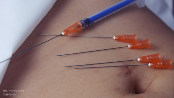 Navel needle-Sasa 5