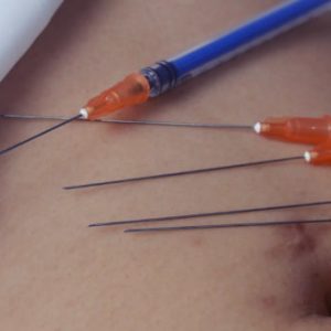 Navel needle-Sasa 5
